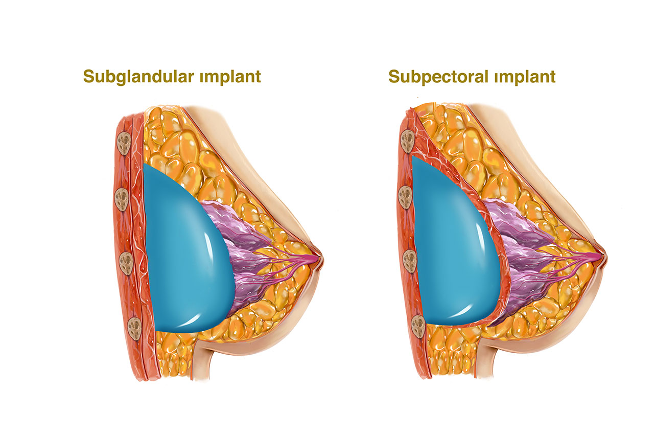Subglandular vs. Submuscular placement